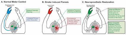 Most patients with ipsilateral hemiparesis had a past history of stroke contralateral to the recent one, resulting in motor deficits contralateral to the earlier lesions. Conceptual Schematic Of Ipsilateral Bci Using The Unaffected Hemisphere Download Scientific Diagram