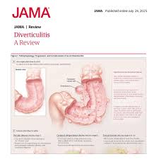 Image result for Diverticulitis