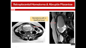 Placenta Lesions Imaging Placenta Image Fluid