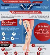 Varicose Veins Symptoms Causes And Treatment