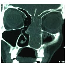 3 mi) northeast of the central business district of pensacola, in escambia county, florida, united states. Contrast Enhancing Ct Scan Of Nose And Pns Coronal Cut Showing Download Scientific Diagram