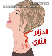 الحزام الناري حبوب تشبه الجدري. Ù„ÙŠØ³ Ù…Ù† Ø§Ù„Ù…Ø£Ù„ÙˆÙ Ø«Ø§Ù†ÙˆÙŠ ØªØ­ØµÙŠÙ„ Ø§Ù„Ø¶Ø±Ø§Ø¦Ø¨ Ø§Ø³Ø¨Ø§Ø¨ Ù…Ø±Ø¶ Ø§Ù„Ø­Ø²Ø§Ù… Ø§Ù„Ù†Ø§Ø±ÙŠ Allseasonsoutdoorkitchens Com