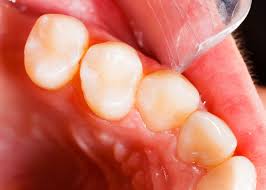 Fillings vary based on the material used to fill the damaged tooth. Dental Fillings Staten Island Ny Dr Joseph Mormino