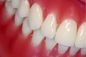 Maybe you would like to learn more about one of these? How A Crown Can Strengthen Damaged Teeth Dentist In Naperville Il