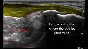 Deformidade haglund de no calcanhar: Haglund Deformity Versus Haglund Syndrome Youtube