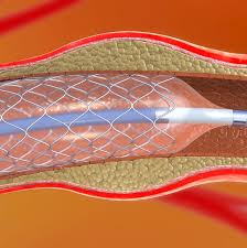 Cirurgia Para Desobstruir Arterias Nao E Mais Eficiente Que Medicamentos 17 11 2019 Uol Vivabem