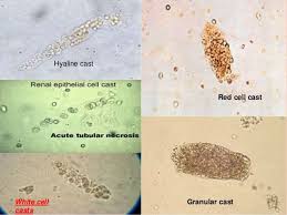 White Cell Casts Google Search Medical Laboratory Science Medical Laboratory Laboratory Science