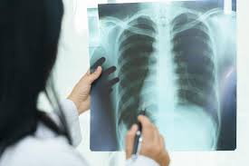 You may experience more symptoms if the collapse affects a larger portion of your lung. Punctured Lung Pneumothorax Symptoms Treatment And Recovery