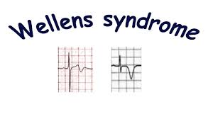 The symptoms coupled with the shape of v1 and the dewinter changes as we advance through the precordial waves mean that at minimum this patient has acs, and repeat ekg's (every 15 minutes, possibly sooner depending on how he's responding to your treatment) and a call to cardiology are in order. De Winter Sign Youtube