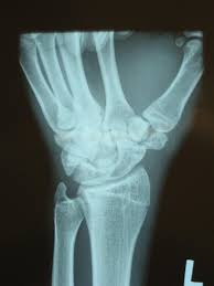 Image result for Trapezoid Bone