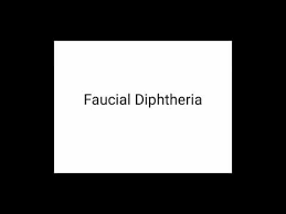 The clinical features of diphtheria are caused by a toxin. Faucial Diphtheria Diseases Of Pharynx Ent Youtube