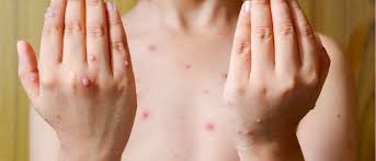 All 2 chickenpox vaccine clinics in malaysia. Everything You Need To Know About Chickenpox London Travel Clinic