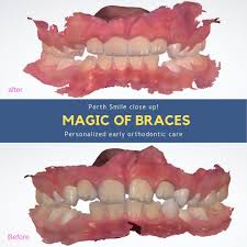 I had braces put on today (fast track braces) so far the pain isnt too bad and they are not really uncomfortable. How To Eat With Braces And Bite Blocks Arxiusarquitectura