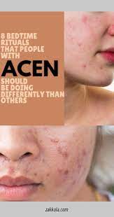 Homemade Acne Remedies What Are The Best Acne Treatments For Sensitive And Dry Skin Check This Acne Treatment Dry Skin Treatment Natural Acne Treatment