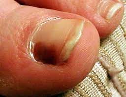 19.02.2018 · most melanomas are related to skin cancer and therefore they can be attributed to spending too much time in the sun, or not using sun creams properly, or even at all. Black Area On Big Toenail Melanoma Or Scary Symptoms