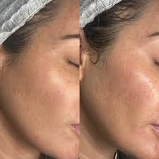 After Hydra Facial
