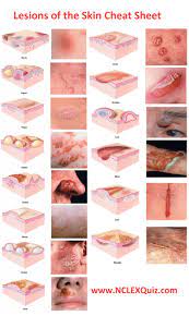 Nursing Dermatology Lesions Of The Skin Cheat Sheet For Nclex A Skin Lesion Is A Part Of The Skin T Nursing School Nursing Information Nursing School Survival