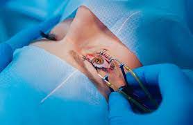 A Beginner S Guide To Lasik Surgery Penn Medicine