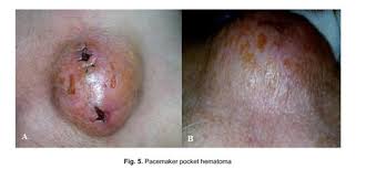 While sometimes awkward, hematomas aren't generally painful for dogs. Subpectoral Pacemaker Implant After Repeated Pocket Complications Due To Senile Pruritus Document Gale Academic Onefile