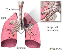 But there are some things that may go unmentioned at your medical appointments. Lung Cancer Small Cell Information Mount Sinai New York