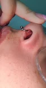 Septum Piercing Infected After 2 Months Piercing