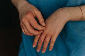 Image result for scabies transmission
