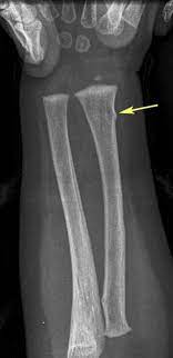 Torus Fracture Picture Teeth Care Radiology Anatomy Images