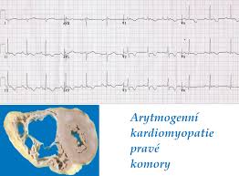 Tento článek bude do značné míry podobný článku trombóza žil dolních končetin, protože z ní plicní embolie velmi často vychází. Arytmogenni Kardiomyopatie Prave Komory Priznaky Projevy Symptomy Ekg Priznaky A Projevy Nemoci