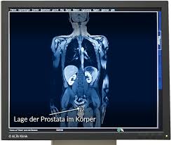 Reviews common tests for these conditions, as well as treatment side effects. Prostata Informationen Zur Vorsorge Und Zur Diagnose