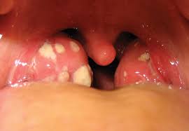 (pathology) a viral infection marked by extreme fatigue, high fever, and swollen lymph nodes. Mononucleosis Definition Symptoms Treatment Britannica