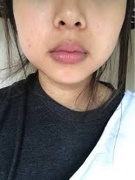 This will lift up the cheeks and the nose. Can I Use Fillers To Fix Facial Asymmetry Photos