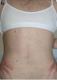 Cushing S Syndrome Wikiwand