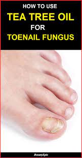 Tea Tree Oil To Treat Toenail Fungus How To Use Toenail Fungus Essential Oils Toenail Fungus Tea Tree Oil Uses