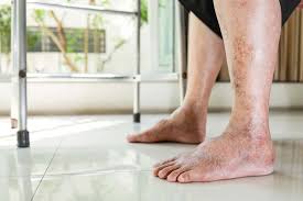 Image result for diabetic toes