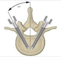 Percutaneous Pedicle Screw Systems | Musculoskeletal Key