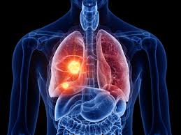 A tumor can block the airway, causing a cough or shortness of breath. New Lung Cancer Treatment Launches