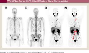 Understanding liver cancer is important if you want to develop an effective treatment plan and live a long and healthy life. Figure 1 From Psma Based Detection Of Prostate Cancer Bone Lesions With F Dcfpyl Pet Ct A Sensitive Alternative To M Tc Mdp Bone Scan And Na F Pet Ct Semantic Scholar