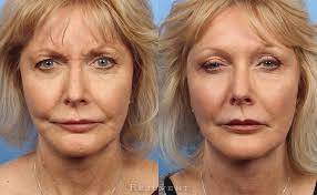 Contact us to learn more about how botox® can help you regain your confidence! Botox Photos Dysport Photos And Xeomin Photos Rejuvent Scottsdale