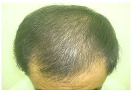 With dietary supplements against hair loss due to malnutrition. A Scientific Hypothesis On The Role Of Nutritional Supplements For Effective Management Of Hair Loss And Promoting Hair Regrowth