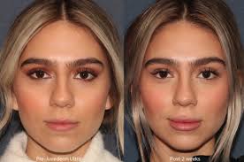 Under eye filler before and after results: 9 Essential Questions To Ask If You Re Considering Facial Fillers Cosmetic Laser Dermatology Skin Specialists In San Diego
