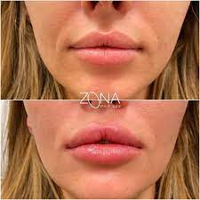 Revanesse® lips™+ is an fda approved hyaluronic acid dermal filler that can be used for submucosal. Pin On Before After Pictures