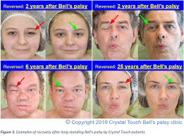 They may include muscle twitching, weakness, or total loss of the ability to move one, and in rare cases, both sides of the face. Facial Synkinesis In Patients With Long Standing Bell S Palsy Is A Reversible Consequence Of Disruption Of Reciprocal Inhibition Caused By Prolonged Absence Of Proprioceptive Feedback Journal Of The Neurological Sciences