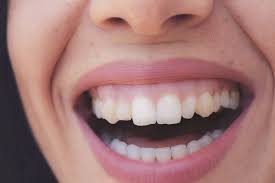Typically caused by a buildup of bacteria in your mouth, gum disease isn't serious at first, but w. Tips For Healthy Gums Painesville Painesville Dental Group