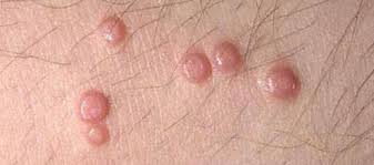 Before developing into a typical cyst, an infected ingrown hair normally begins as a small or big pimple. Causes Cures For Itchy Vaginal Lumps Bumps And Sores Youmemindbody