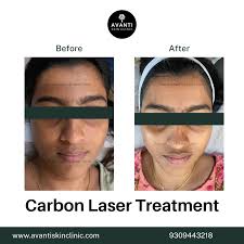 Stretch Marks Removal Near Me in Pune @ Cost Starting ₹30000/-