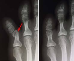 Check spelling or type a new query. Toe And Forefoot Fractures Orthoinfo Aaos