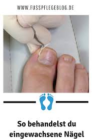 so behandelst du eingewachsene nagel eingewachsener nagel nagel zehennagel