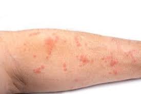 Image result for scabies norvegica