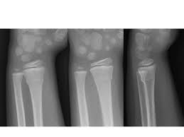 Ongoing stiffness, aching or disability. Buckle Fracture Ortho Teaching Files Nuem Blog