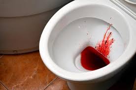 Image result for Blood in stool